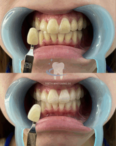 Teeth Whitening SG